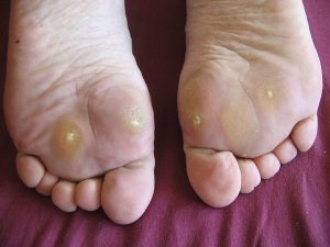 Tìm hiểu bệnh chai chân theo y học cổ truyền