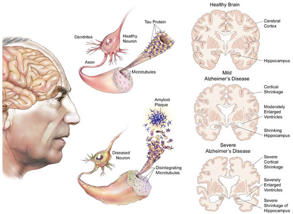 Chế độ dinh dưỡng Alzheimer (thoái hóa não)