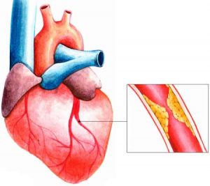 Bài thuốc hay phòng thiếu máu cơ tim trong YHCT