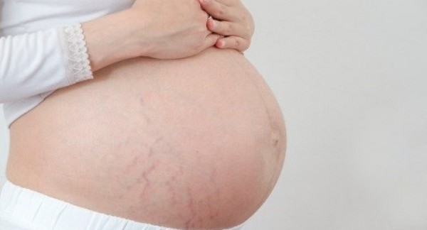 Bệnh rạn da thường xuất hiện ở phụ nữ mang thai